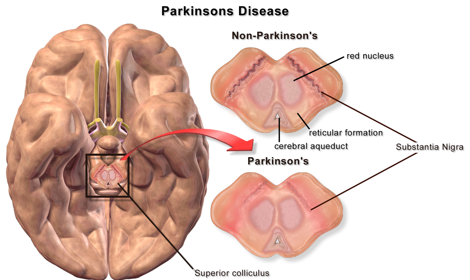 Parkinsons